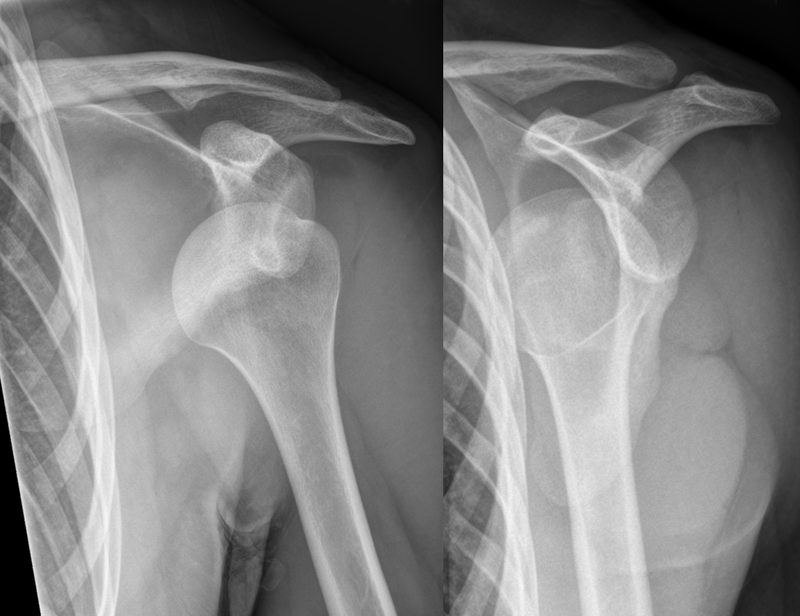 understanding-the-causes-of-shoulder-dislocation-and-instability